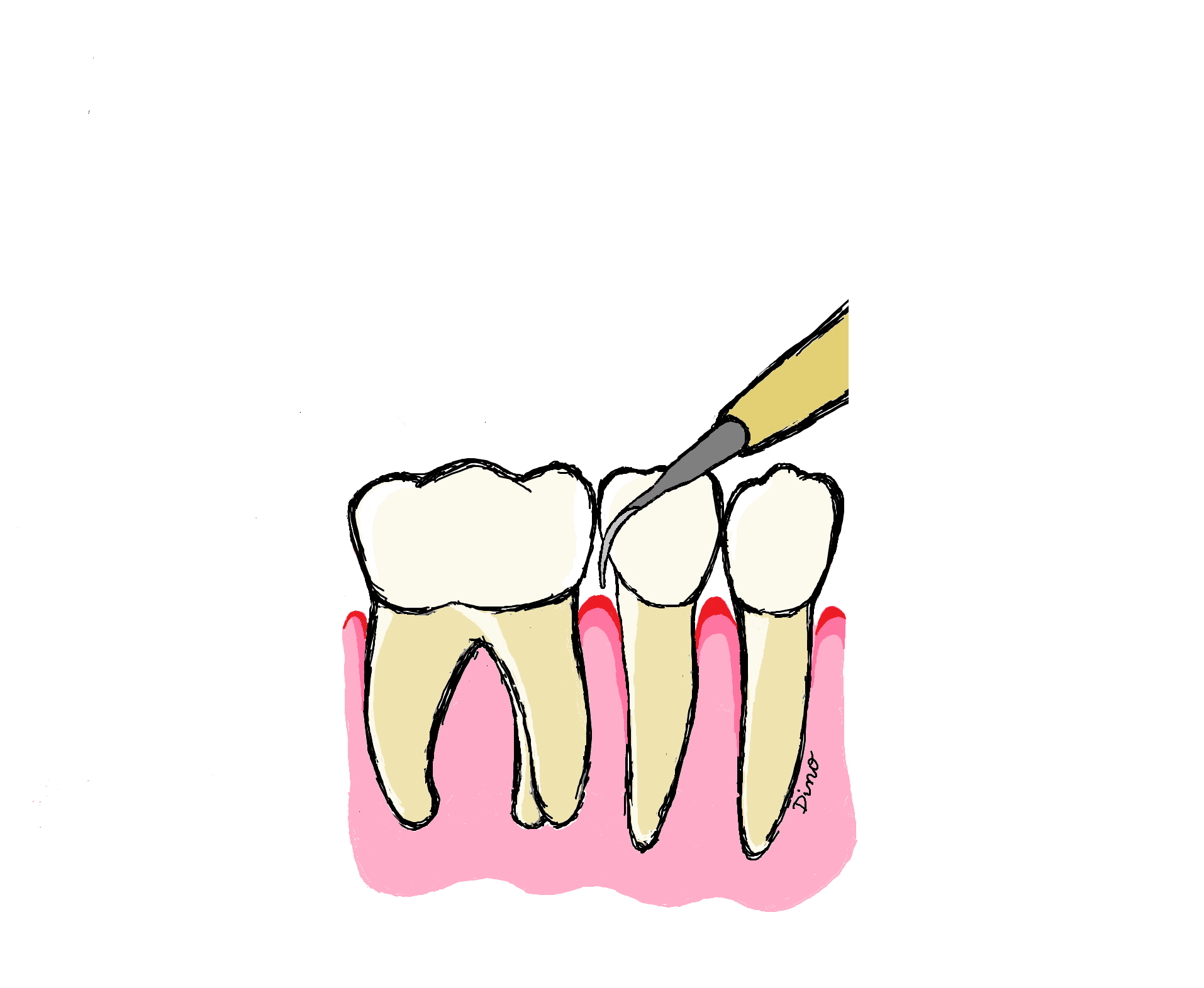 GUM SURGERY & CLEANINGS